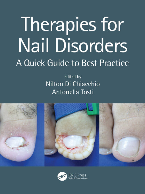 Title details for Therapies for Nail Disorders by Nilton Di Chiacchio - Wait list